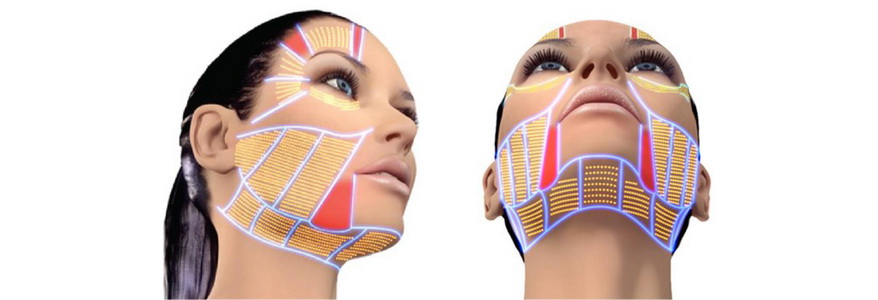 Ulthera.jpg Ulthera.jpg