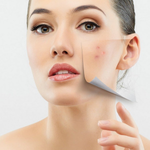 Без прыщей! Битва с проблемной кожей