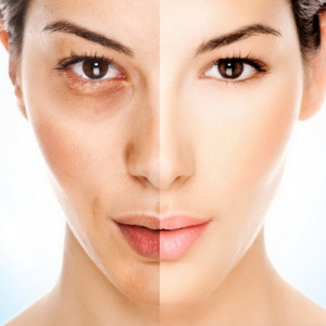 Подтяжка лица методом биоармирования. Максимум эффекта - минимум осложнений!